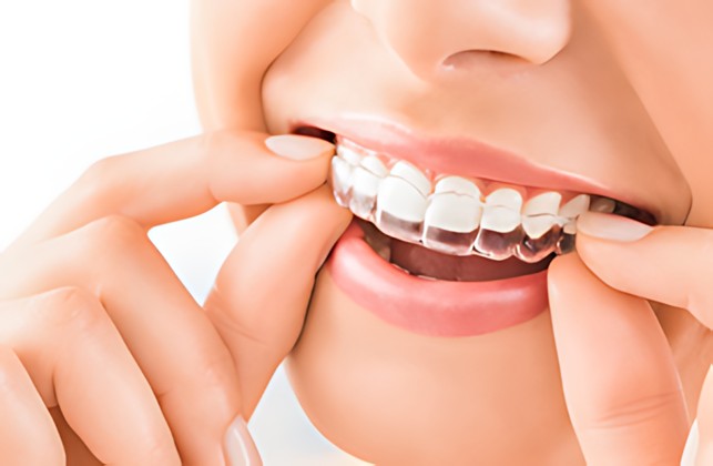 apparecchio dentale trasparente a Varedo