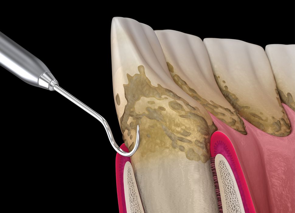 Pulizia profonda dei denti