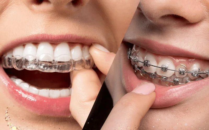 Invisalign Vs. Bracket