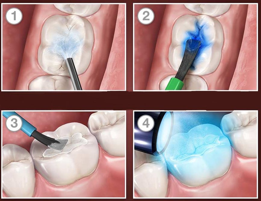 Sigillature o Vernicette dei denti posteriori