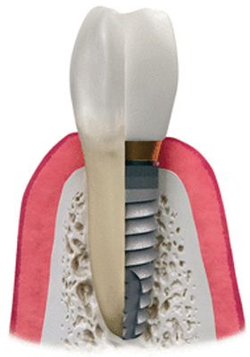 Impianti dentali